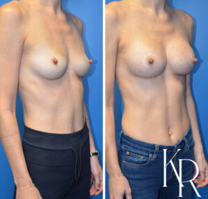 Before and after breast augmentation