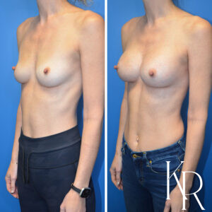 Before and after breast augmentation
