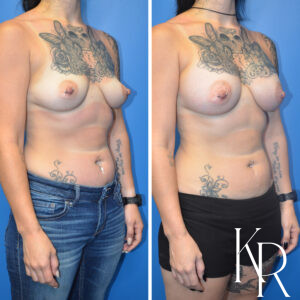 Before and after breast augmentation