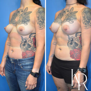 Before and after breast augmentation