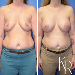 Before and after breast augmentation