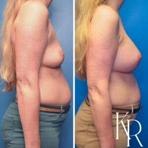 Before and after breast augmentation