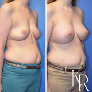 Before and after breast augmentation