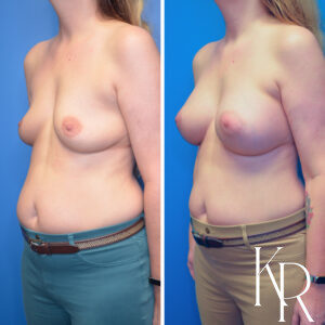 Before and after breast augmentation