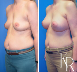 Before and after breast augmentation