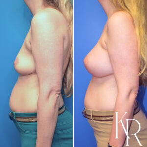 Before and after breast augmentation
