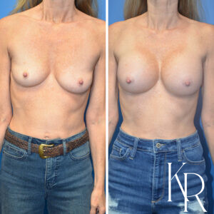 Before and after breast augmentation