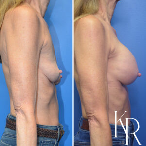 Before and after breast augmentation