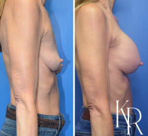 Before and after breast augmentation