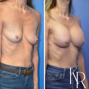 Before and after breast augmentation