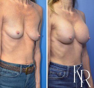 Before and after breast augmentation