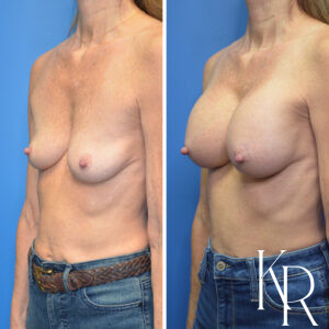 Before and after breast augmentation