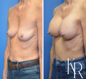 Before and after breast augmentation