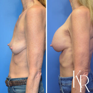 Before and after breast augmentation