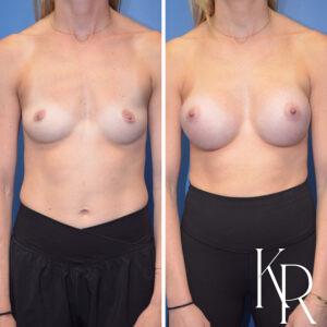 Before and after breast augmentation