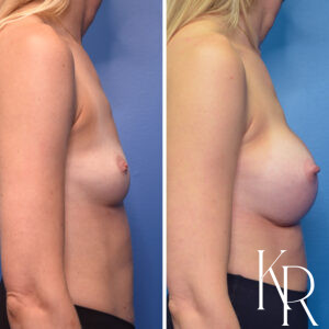 Before and after breast augmentation