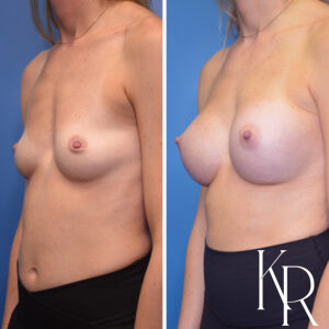 Before and after breast augmentation