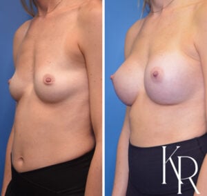 Before and after breast augmentation