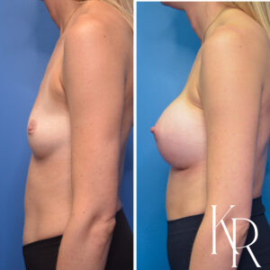 Before and after breast augmentation