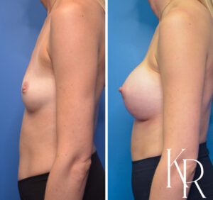 Before and after breast augmentation