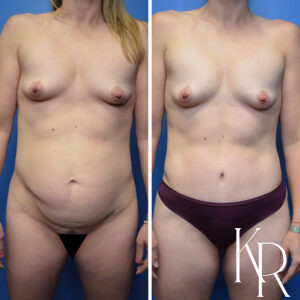Before and after abdominoplasty