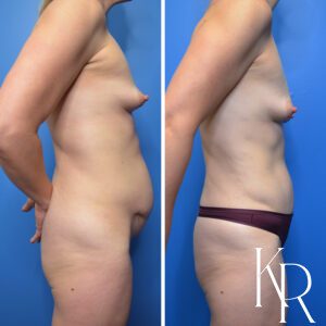 Before and after abdominoplasty
