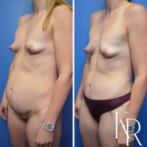 Before and after abdominoplasty