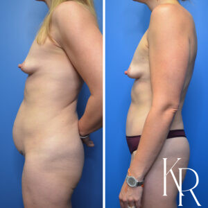Before and after abdominoplasty