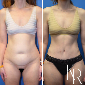 Before and after abdominoplasty