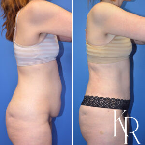 Before and after abdominoplasty