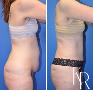 Before and after abdominoplasty