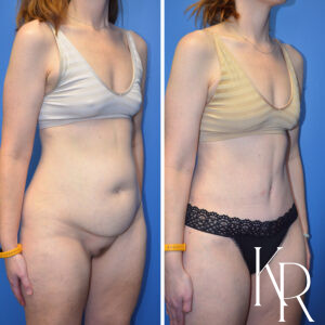Before and after abdominoplasty