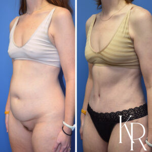 Before and after abdominoplasty