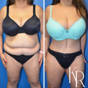 Before and after abdominoplasty