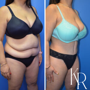 Before and after abdominoplasty