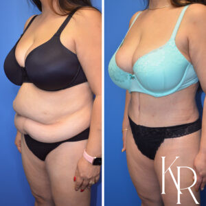 Before and after abdominoplasty