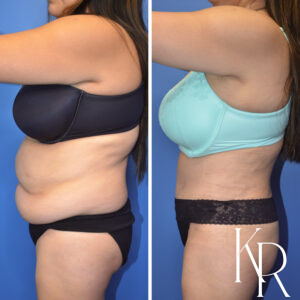 Before and after abdominoplasty
