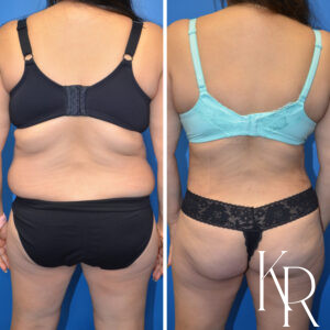 Before and after abdominoplasty