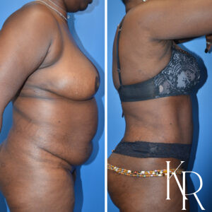 Before and after abdominoplasty