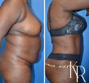 Before and after abdominoplasty