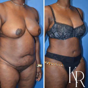 Before and after abdominoplasty