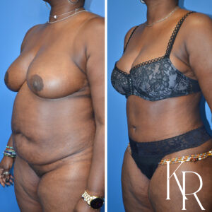 Before and after abdominoplasty