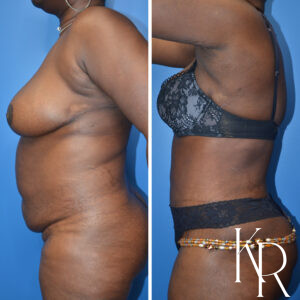 Before and after abdominoplasty