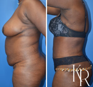 Before and after abdominoplasty