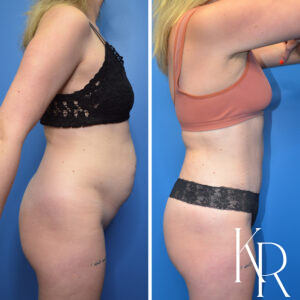 Before and after abdominoplasty