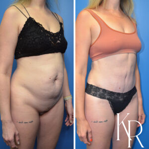 Before and after abdominoplasty