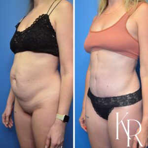 Before and after abdominoplasty