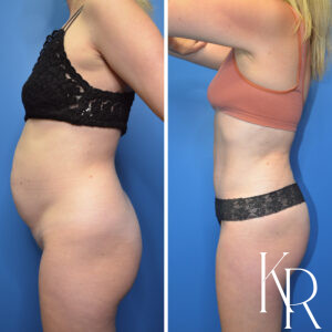 Before and after abdominoplasty