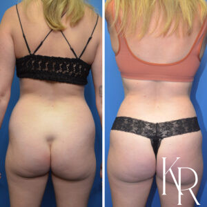 Before and after abdominoplasty
