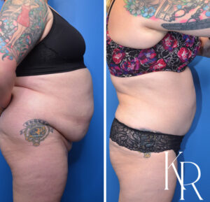Before and after abdominoplasty